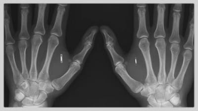 Banking Insider Warns CBDCs Will Be Implanted Chips - Watch