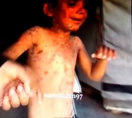 Small Pox Time Release Death Injections in Gaza: - Watch