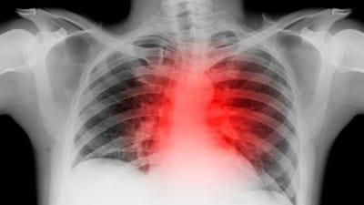 Cardiologist Dr. McCullough On Damar Hamlin: 'Leading Concern Here Is Vaccine-Induced Myocarditis'