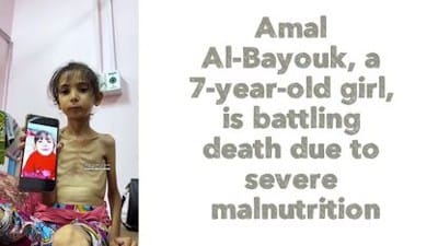 Amal Al-Bayouk, a 7-year-old girl, is battling death due to severe malnutrition - Watch
