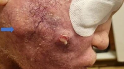 Insane & Gross Turbo Cancer Cases From Covid Shots Flooding Social Media